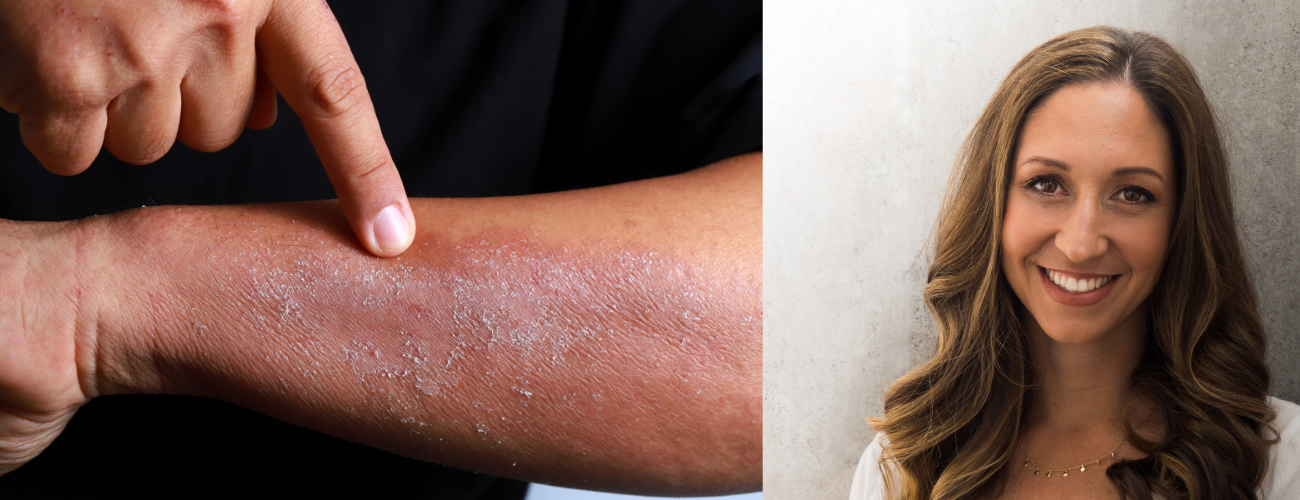 Lets talk ECZEMA – with Belinda Kirkpatrick, Naturopath and Nutritionist