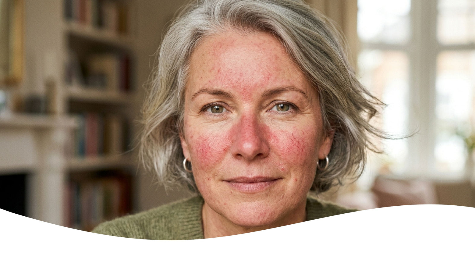 Sunscreen for Rosacea: Why Zinc Oxide Beats Chemical Filters