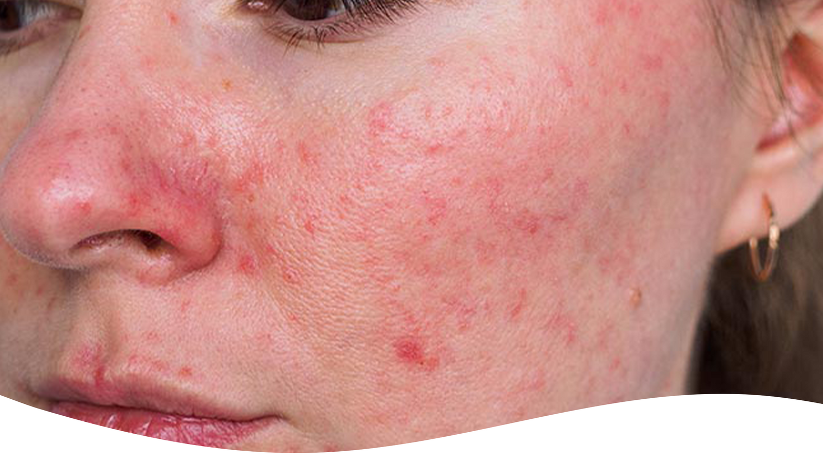 Is Zinc Sunscreen Safe for Sensitive Skin? What Dermatologists Say
