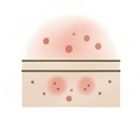 Rosacea